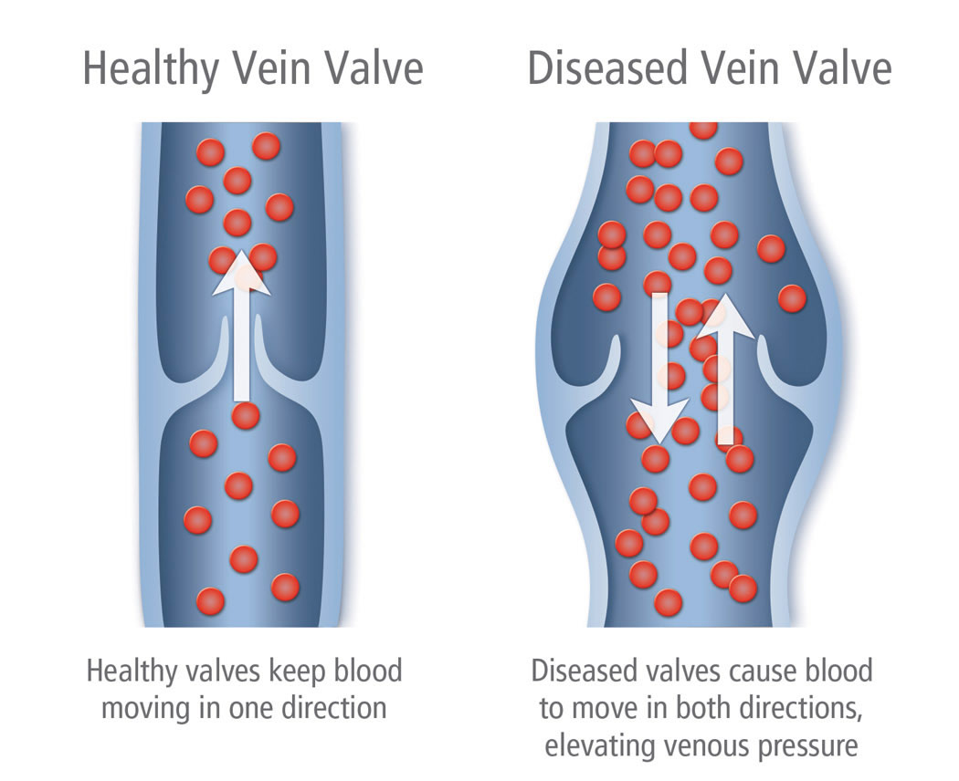 Healthy-vs.-Diseased-Vein-Valve-Illustration-varicose vein